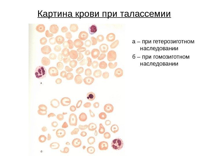 Картина крови при талассемии а – при гетерозиготном наследовании б – при гомозиготном наследовании