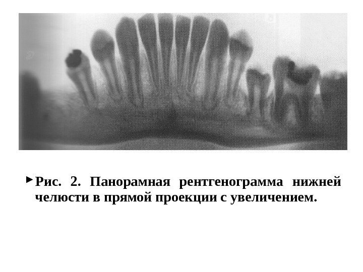  Рис.  2.  Панорамная рентгенограмма нижней челюсти в прямой проекции с увеличением.