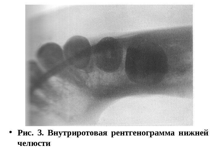  • Рис.  3.  Внутриротовая рентгенограмма нижней челюсти 