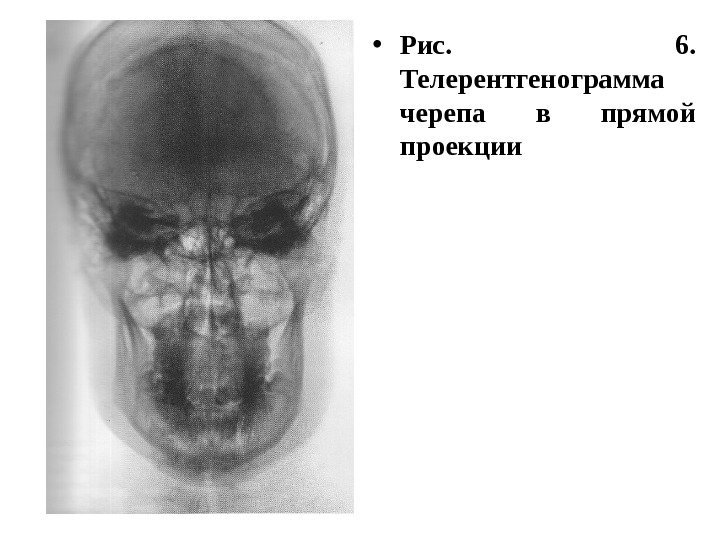  • Рис.  6.  Телерентгенограмма черепа в прямой проекции 
