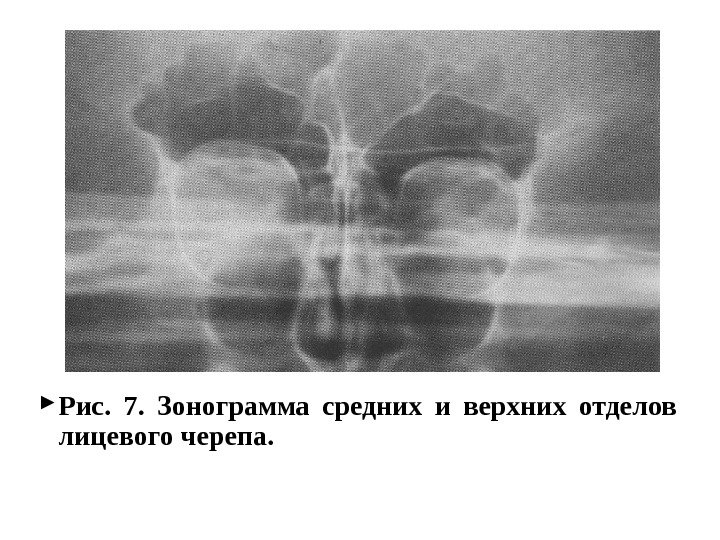  Рис.  7.  Зонограмма средних и верхних отделов лицевого черепа. 