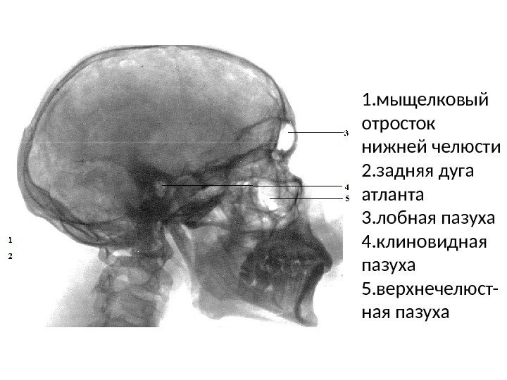1. мыщелковый отросток нижней челюсти 2. задняя дуга атланта 3. лобная пазуха 4. клиновидная