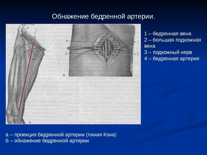   Обнажение бедренной артерии. 1 – бедренная вена 2 – большая подкожная вена