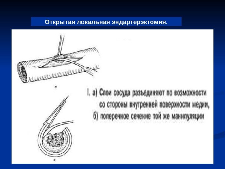   Открытая локальная эндартерэктомия. 