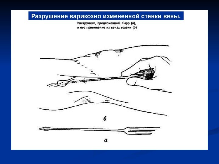   Разрушение варикозно измененной стенки вены. 