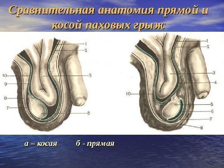 Сравнительная анатомия прямой и косой паховых грыж а – косая   б -