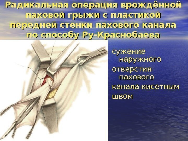 Радикальная операция врождённой паховой грыжи с пластикой передней стенки пахового канала по способу Ру-Краснобаева