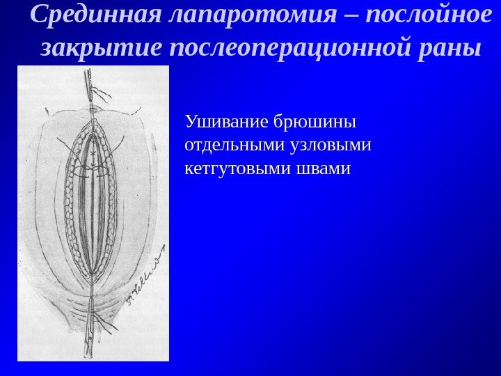   Срединная лапаротомия – послойное  закрытие послеоперационной раны Ушивание брюшины отдельными узловыми