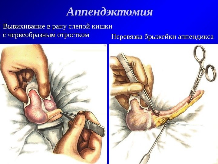   Аппендэктомия Вывихивание в рану слепой кишки с червеобразным отростком Перевязка брыжейки аппендикса