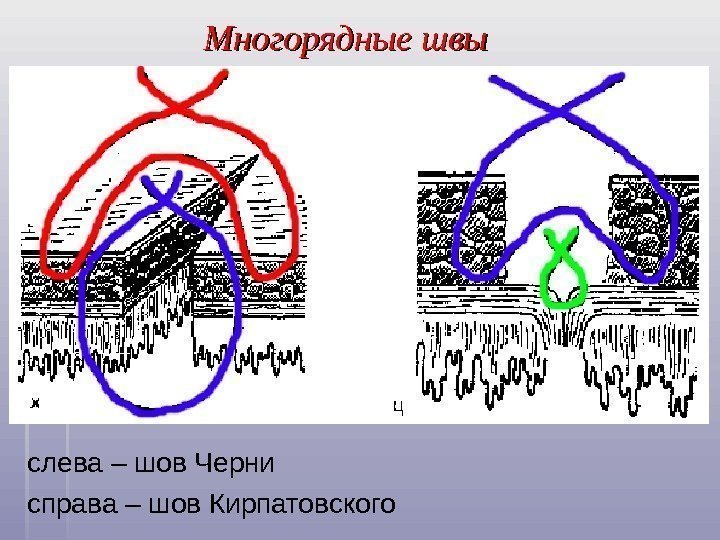   Многорядные швы слева – шов Черни справа – шов Кирпатовского  