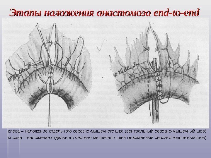   Этапы наложения анастомоза end-to-end слева – наложение отдельного серозно-мышечного шва (вентральный серозно-мышечный