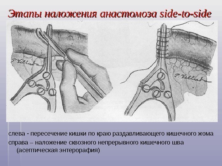   Этапы наложения анастомоза side-to-side слева - пересечение кишки по краю раздавливающего кишечного
