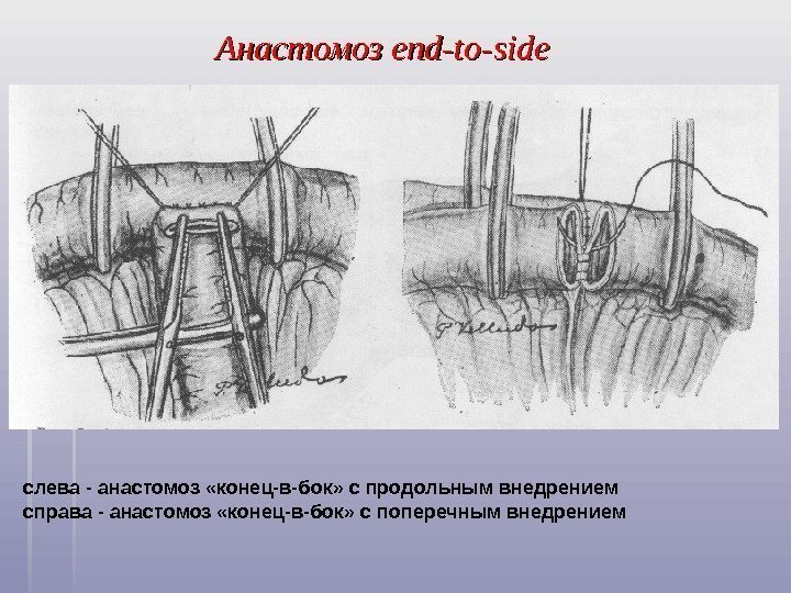   Анастомоз end-to-side слева - анастомоз «конец-в-бок» с продольным внедрением справа - анастомоз