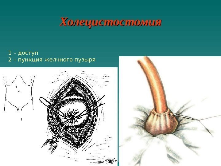   Холецистостомия 1 – доступ 2 – пункция желчного пузыря 