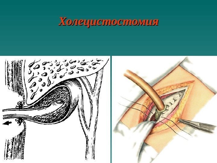   Холецистостомия 