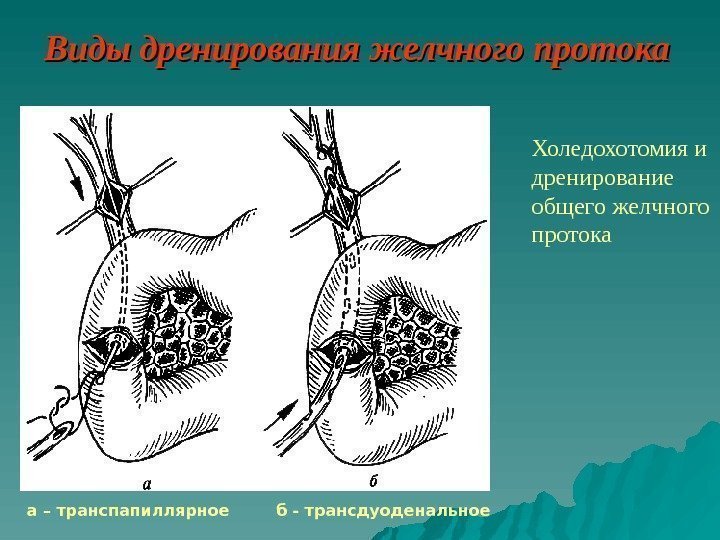   Виды дренирования желчного протока Холедохотомия и дренирование общего желчного протока а –