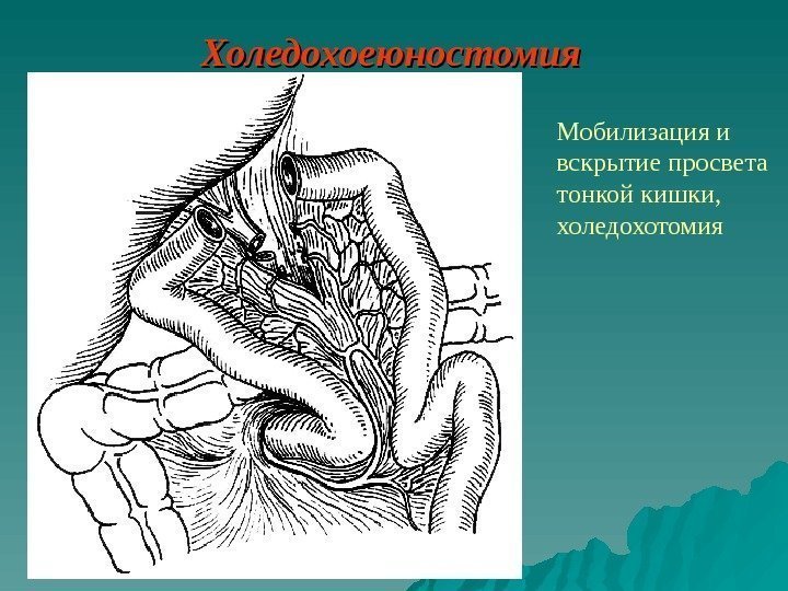   Холедохоеюностомия Мобилизация и вскрытие просвета тонкой кишки,  холедохотомия 