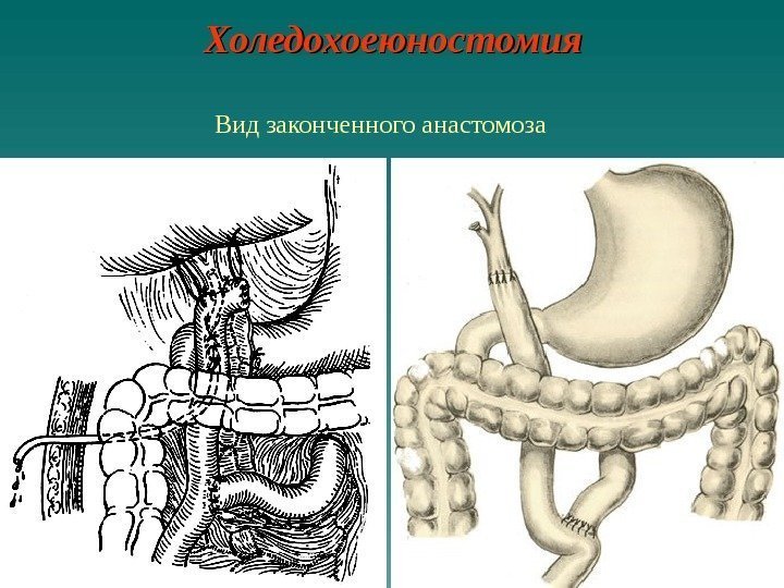   Холедохоеюностомия Вид законченного анастомоза 