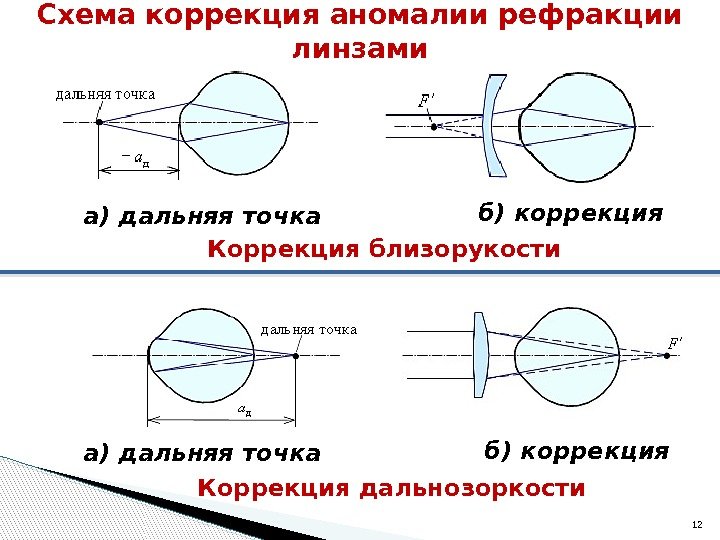 Схема коррекция аномалии рефракции линзами а) дальняя точка б) коррекция Коррекция близорукости а) дальняя