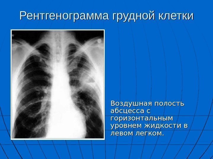   Рентгенограмма грудной клетки Воздушная полость абсцесса с горизонтальным уровнем жидкости в левом