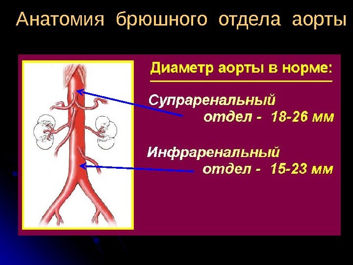 Аневризма брюшной аорты фото