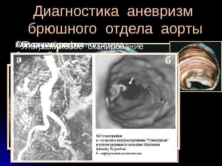  Диагностика аневризм  брюшного отдела аорты Обзорная рентгенограмма  брюшной полости. Ангиография Ультразвуковое