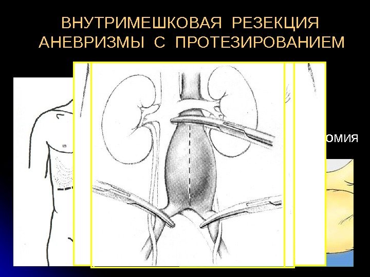   ДОСТУПЫ: Лапаротомия  По Робу  Торакофренолюмботомия. ВНУТРИМЕШКОВАЯ РЕЗЕКЦИЯ  АНЕВРИЗМЫ С