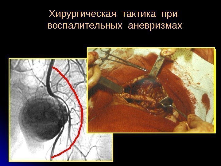  Хирургическая тактика при  воспалительных аневризмах 