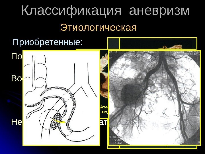  Классификация аневризм Этиологическая Посттравматические  (в т. ч.  ятрогенные) Воспалительные (в т.