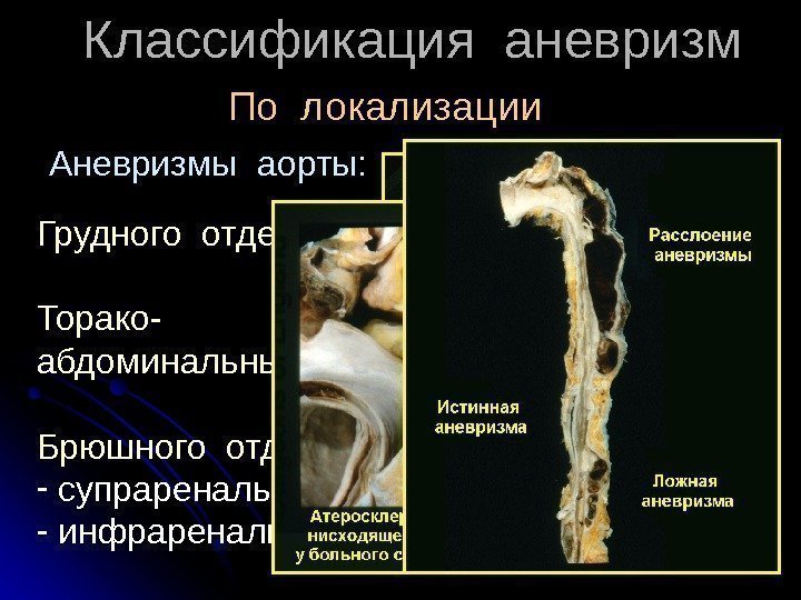  Классификация аневризм По локализации Грудного отдела Торако- абдоминальные Брюшного отдела -  супраренальные;