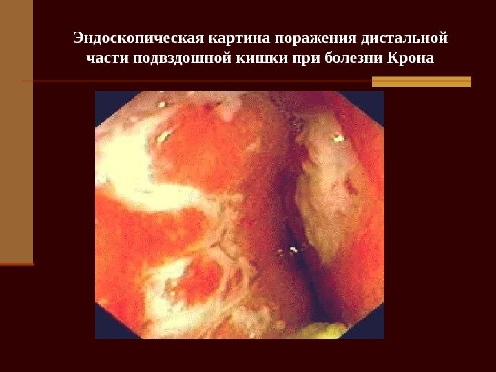   Эндоскопическая картина поражения дистальной части подвздошной кишки при болезни Крона 