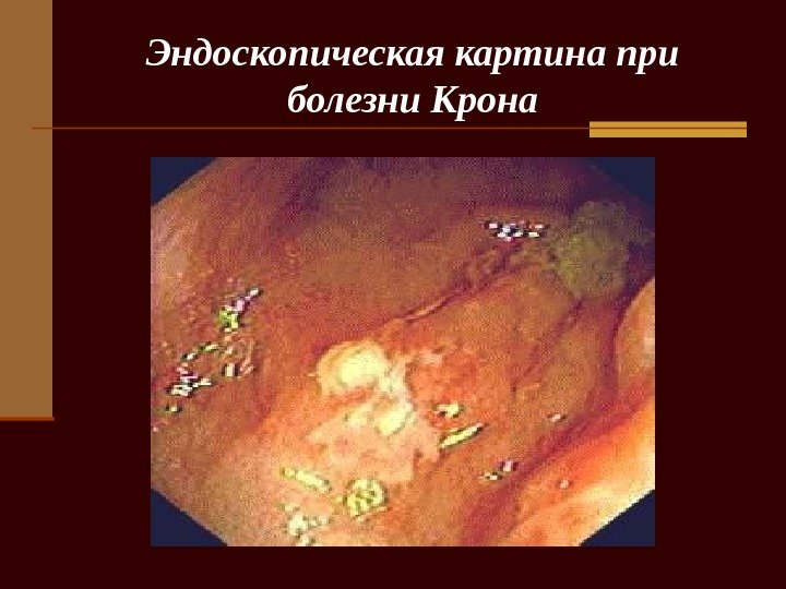   Эндоскопическая картина при болезни Крона 
