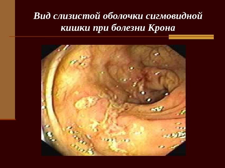   Вид слизистой оболочки сигмовидной кишки при болезни Крона 