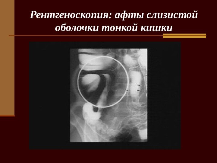   Рентгеноскопия: афты слизистой оболочки тонкой кишки 