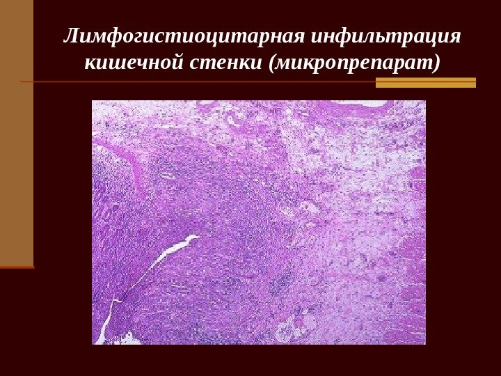  Лимфогистиоцитарная инфильтрация кишечной стенки (микропрепарат) 