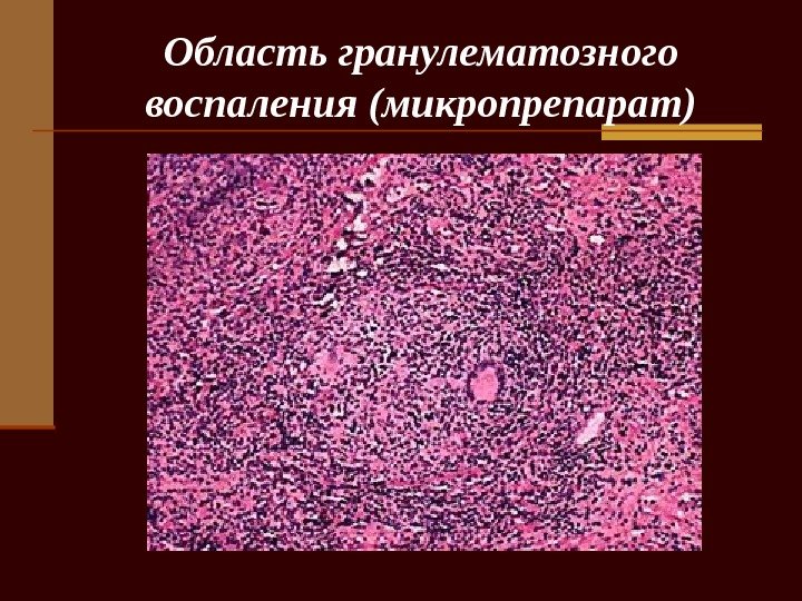   Область гранулематозного воспаления (микропрепарат) 