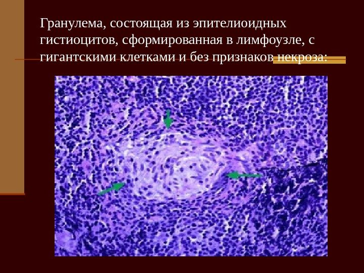   Гранулема, состоящая из эпителиоидных гистиоцитов, сформированная в лимфоузле, с гигантскими клетками и