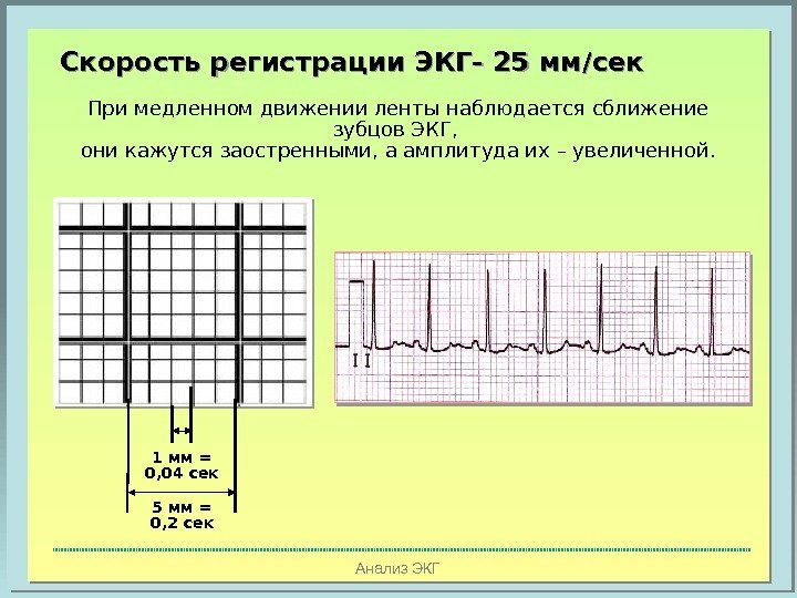 Анализ ЭКГПри медленном движении ленты наблюдается сближение зубцов ЭКГ,  они кажутся заостренными, а