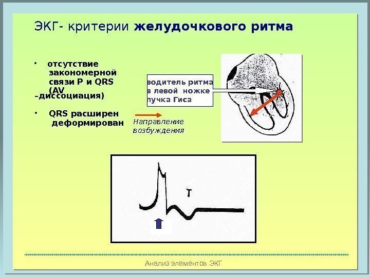 Анализ элементов ЭКГЭКГ- критерии желудочкового ритма водитель ритма в левой ножке пучка Гиса •