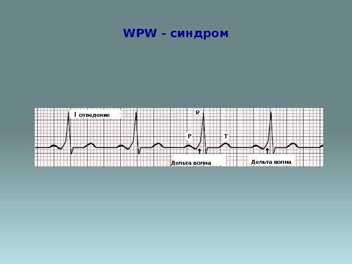 WPW - синдром I  отведение Дельта волна 