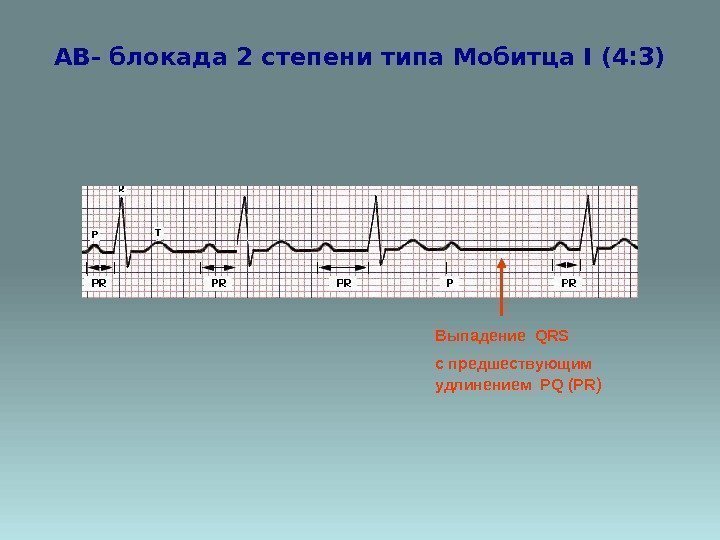 AВ- блокада 2 степени типа Мобитца I (4: 3) Выпадение QRS c предшествующим удлинением