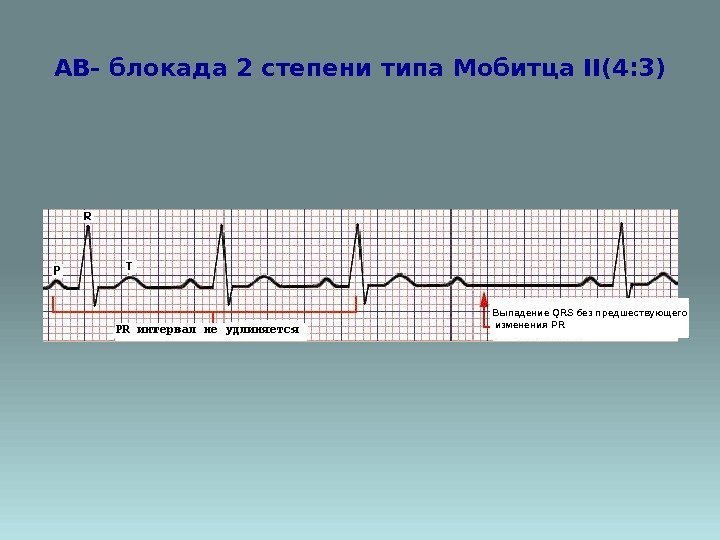 AВ- блокада 2 степени типа Мобитца II(4: 3) Выпадение QRS без предшествующего  изменения
