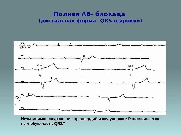 Полная АВ- блокада (дистальная форма –QRS широкий) V 1 V 2 V 3 V