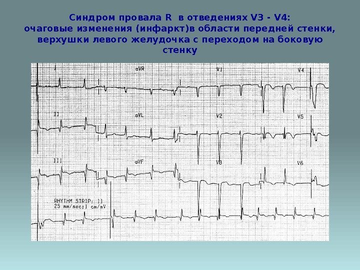 Синдром провала R в отведениях V 3 - V 4: очаговые изменения (инфаркт)в области