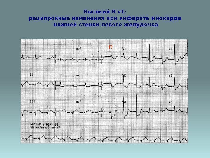 Высокий R v 1: реципрокные изменения при инфаркте миокарда нижней стенки левого желудочка R