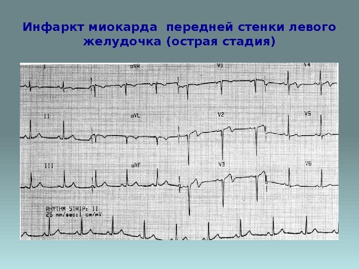 Инфаркт миокарда передней стенки левого желудочка (острая стадия) 