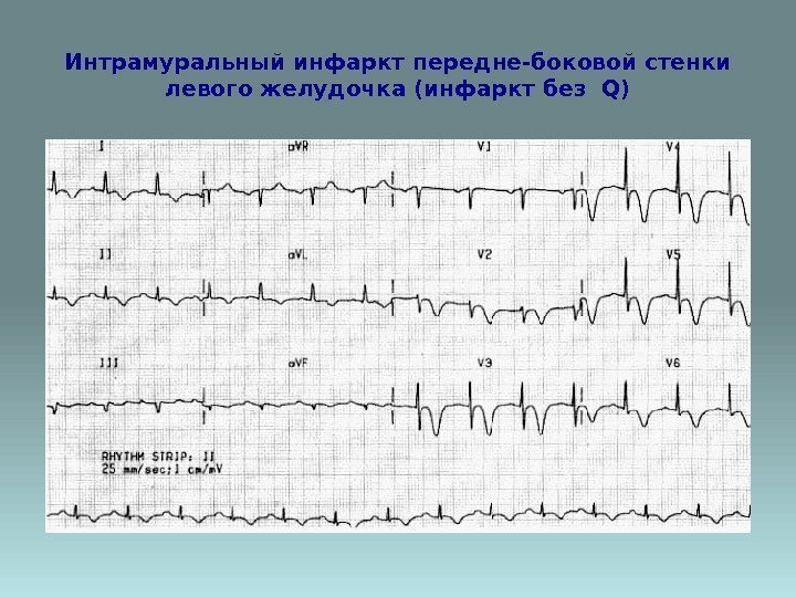 Интрамуральный инфаркт передне-боковой стенки левого желудочка (инфаркт без Q) 