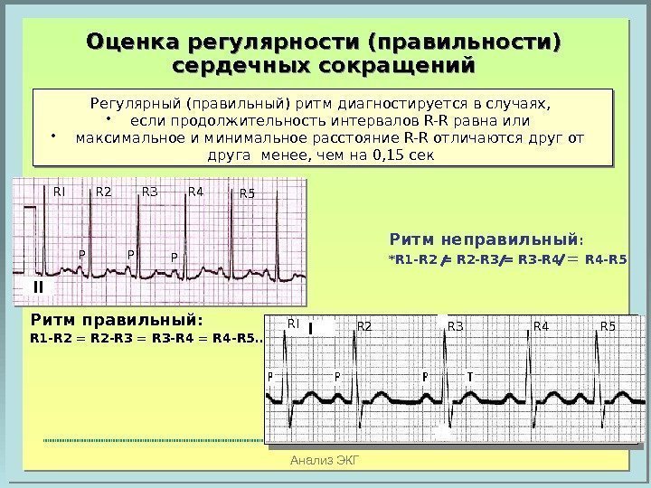Анализ ЭКГОценка регулярности (правильности) сердечных сокращений Регулярный (правильный) ритм диагностируется в случаях,  •