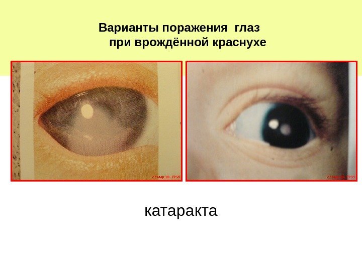   Варианты поражения глаз при врождённой краснухе катаракта 