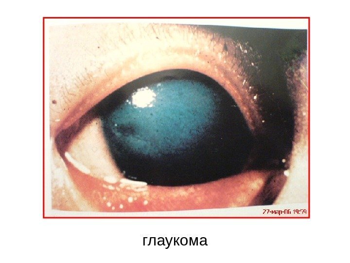   глаукома 